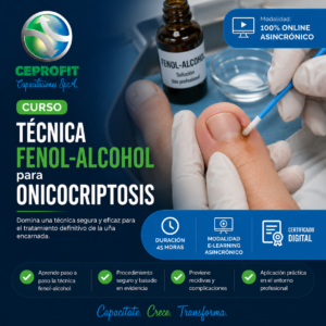 Técnica Fenol-Alcohol para Onicocriptosis