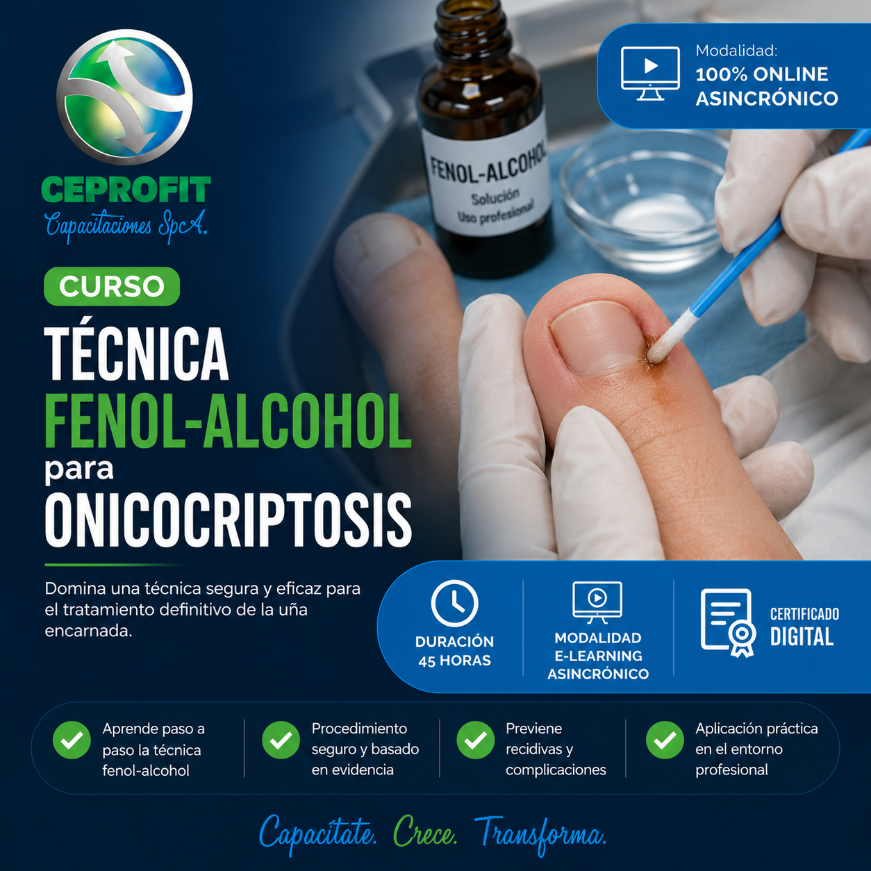 Técnica Fenol-Alcohol para Onicocriptosis